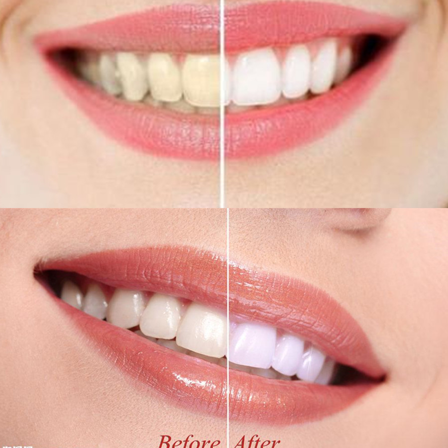 ถ่านไม้ไผ่ฟันฟันทันตกรรมสูตร L - Teeth Whitening Ulta บทวิจารณ์และราคา