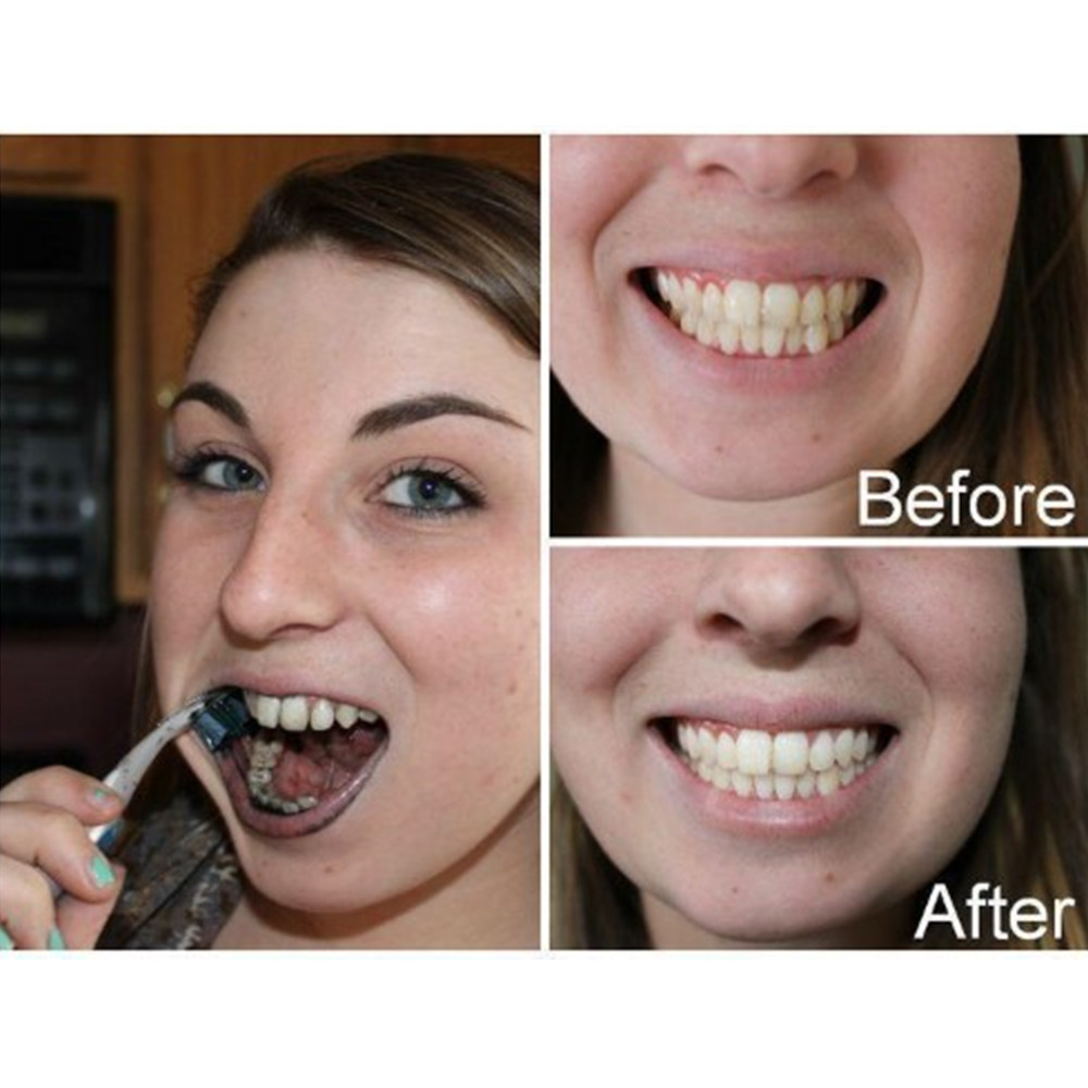 ถ่านไม้ไผ่ฟันฟันทันตกรรมสูตร L - Teeth Whitening Ulta บทวิจารณ์และราคา