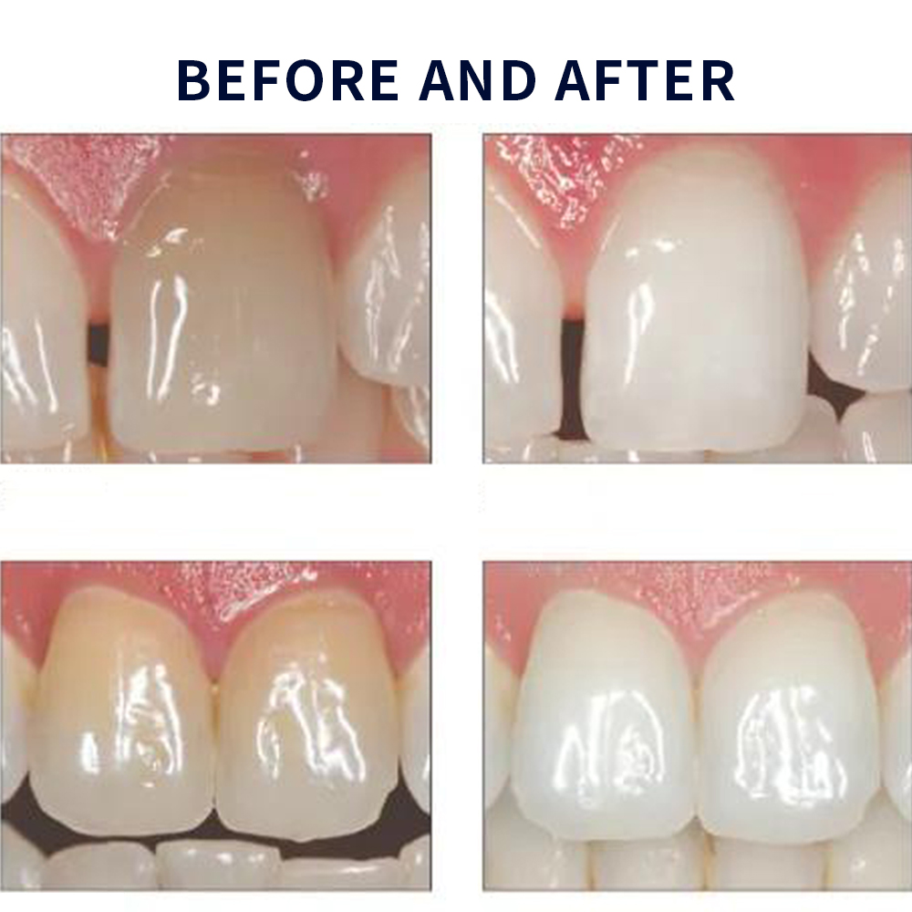 20% pF 20 16ชุดเจล8x1.2มล. ชุด - Teeth Whitening Ulta บทวิจารณ์และราคา