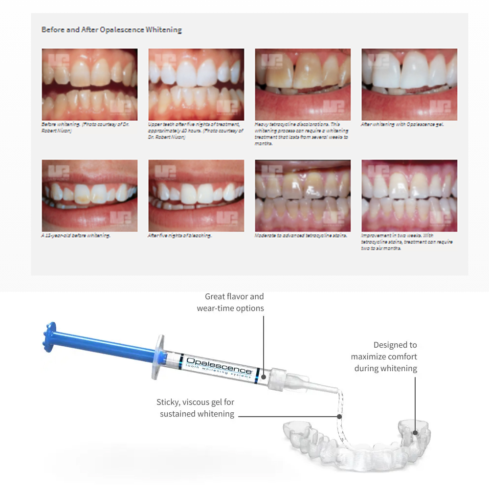 20% pF 20 16ชุดเจล8x1.2มล. ชุด - Teeth Whitening Ulta บทวิจารณ์และราคา